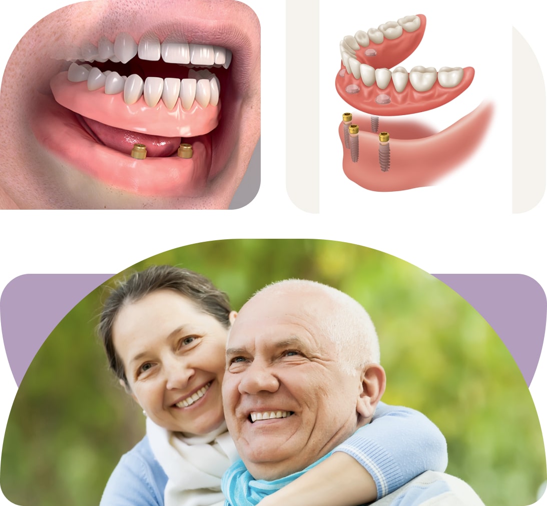 Dental Bridge Treatment