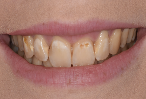 Dental Bonding - Before and After at Preventive Dentistry Braddon