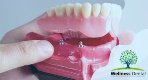 snap in dentures