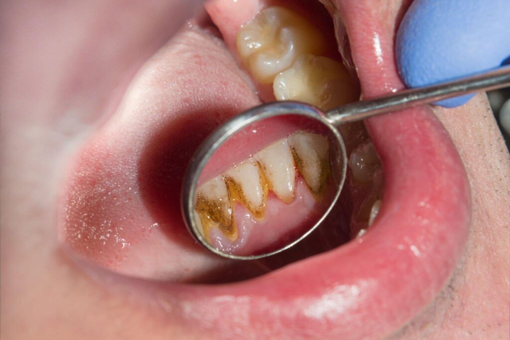 Tooth Plaque