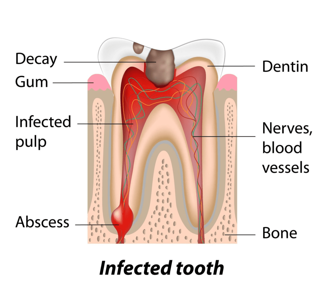 Gum Abscess