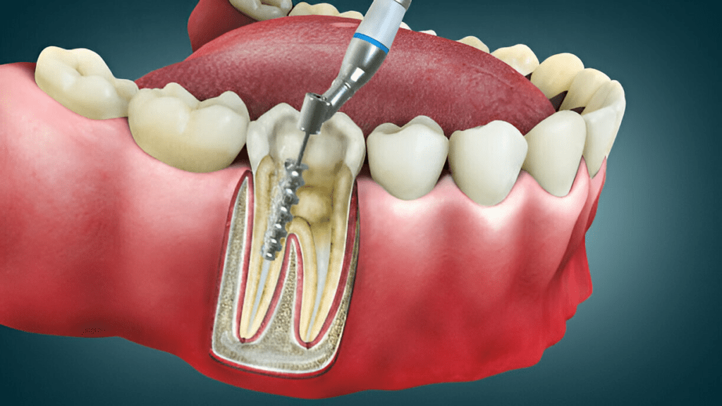 Step-by-Step Guide: How Long Does a Root Canal Take?