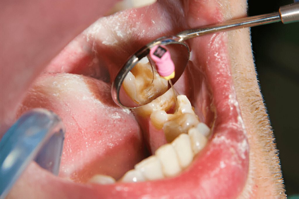 Cleaning Root Canals