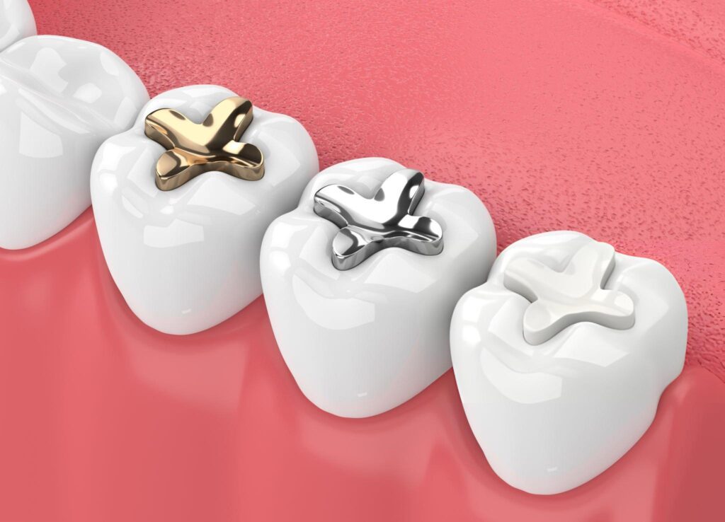 ceramic fillings