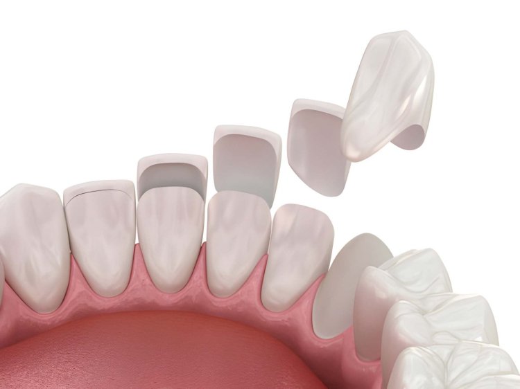 veneers