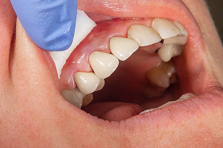 front tooth crowns