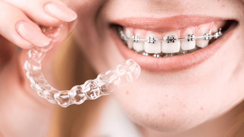 Braces and Orthodontic Appliances