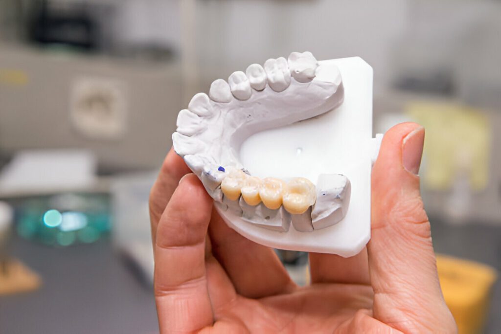 Pros and cons of dental bridges