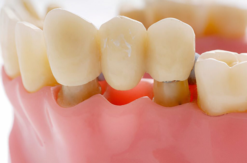 Dental bridges