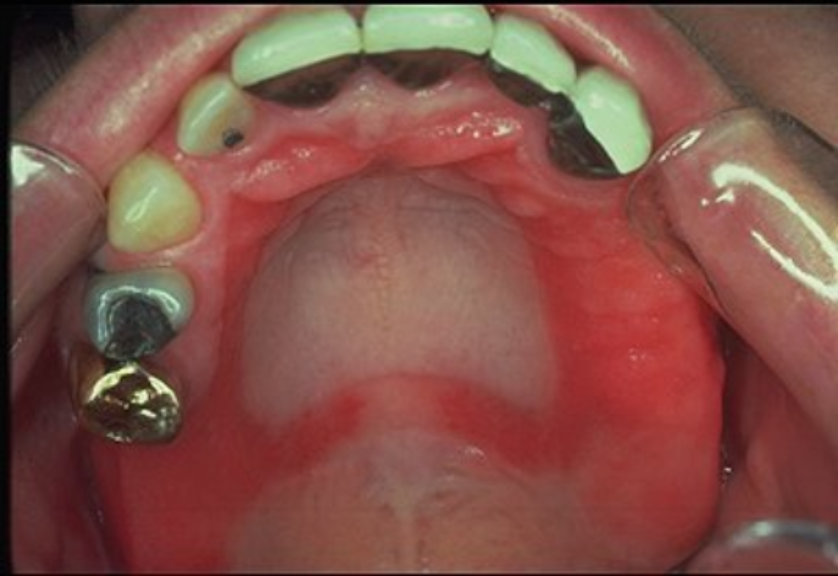 Understanding Denture Stomatitis