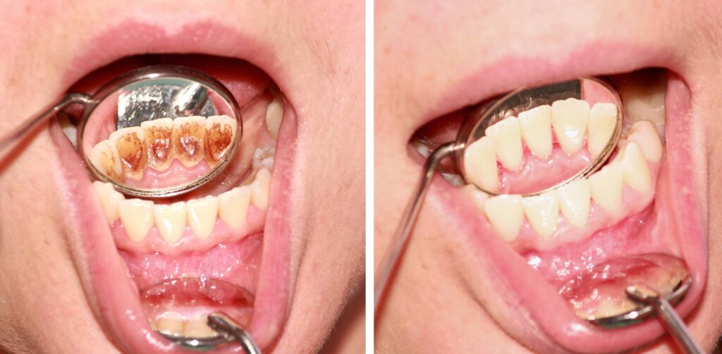 Before and after removal of tartar. Reflection in the mirror