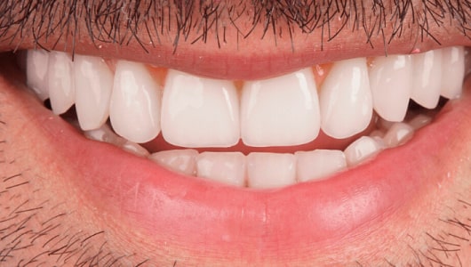 Teeth Veneers After