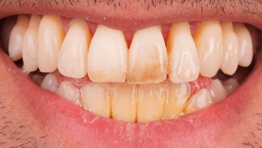 Teeth Veneers Before
