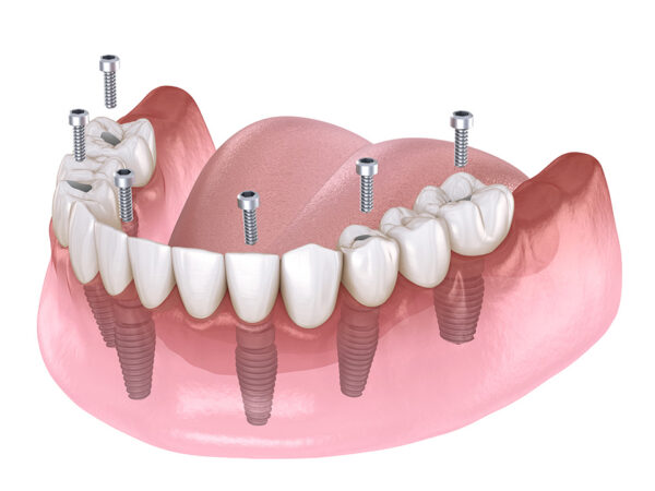 Fixed Full arch implants