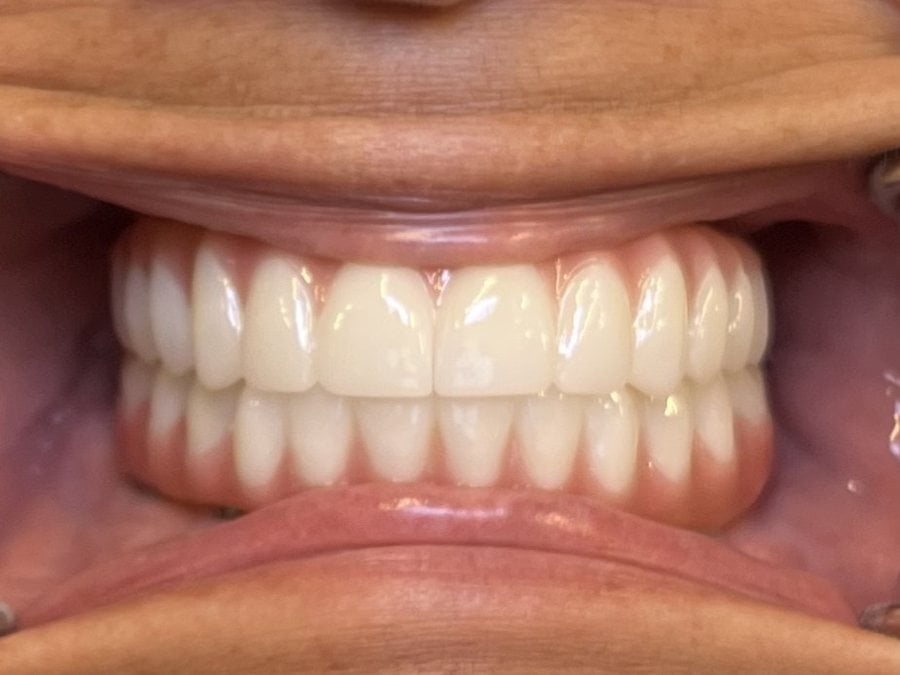 After: fixed full-arch dental implants by Dr. Matthew McClement at Wellness Dental Mesa