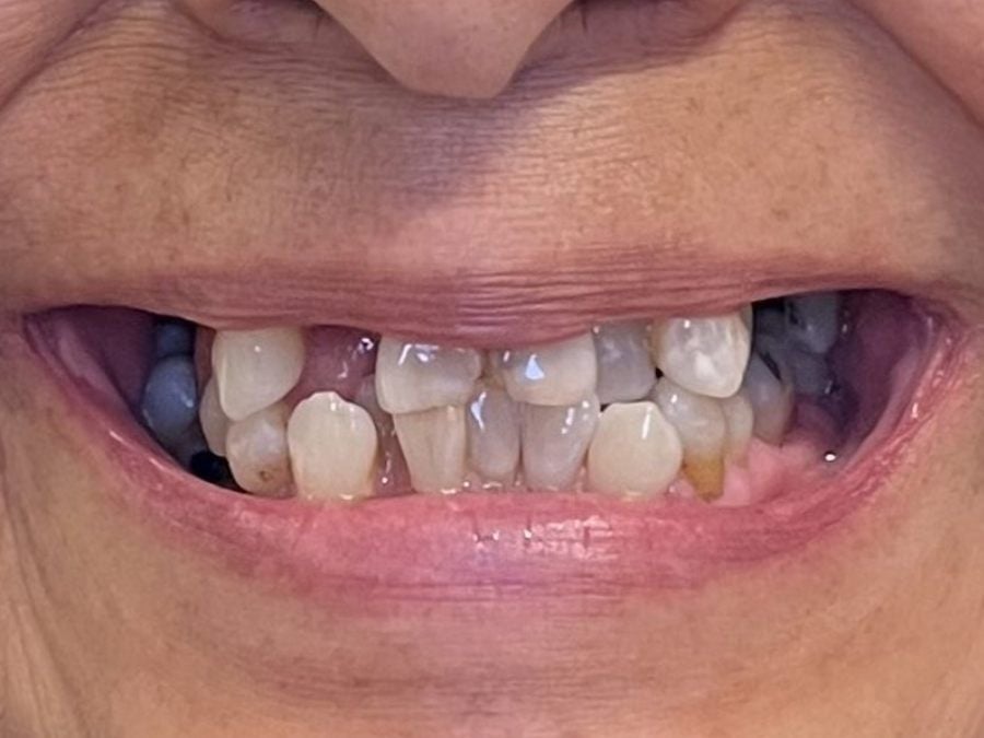 Before: full-arch dental implant case treated at Wellness Dental Mesa