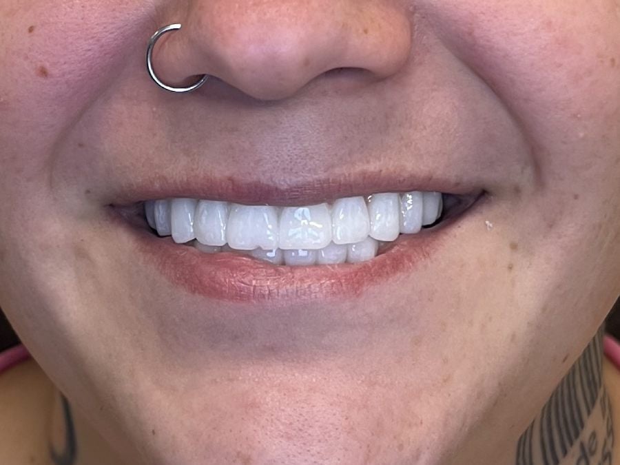After: fixed full-arch dental implants by Dr. Matthew McClement at Wellness Dental Mesa