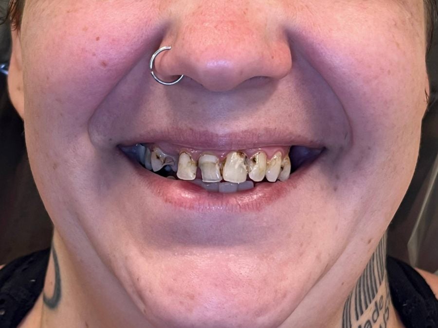 Before: full-arch dental implant case treated at Wellness Dental Mesa