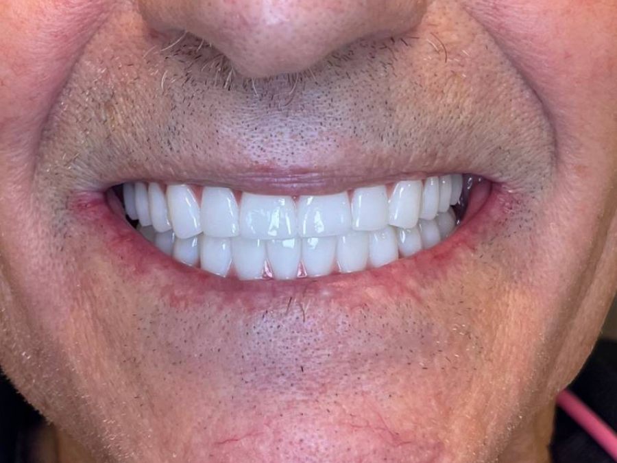 After — fixed full-arch dental implants by Dr. Matthew McClement at Wellness Dental Mesa