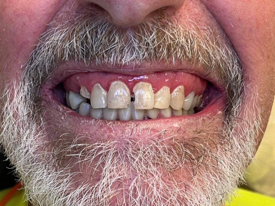 Before — full-arch dental implant case treated by Dr. Matthew McClement at Wellness Dental Mesa