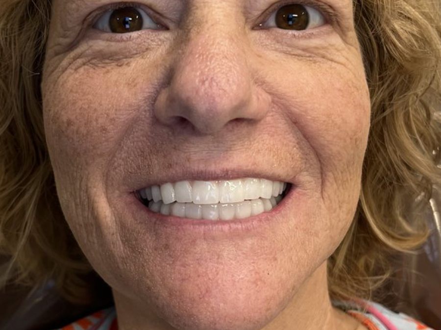 After — fixed full-arch dental implants by Dr. Matthew McClement at Wellness Dental Mesa