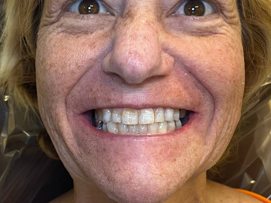 Before — full-arch dental implant case treated by Dr. Matthew McClement at Wellness Dental Mesa