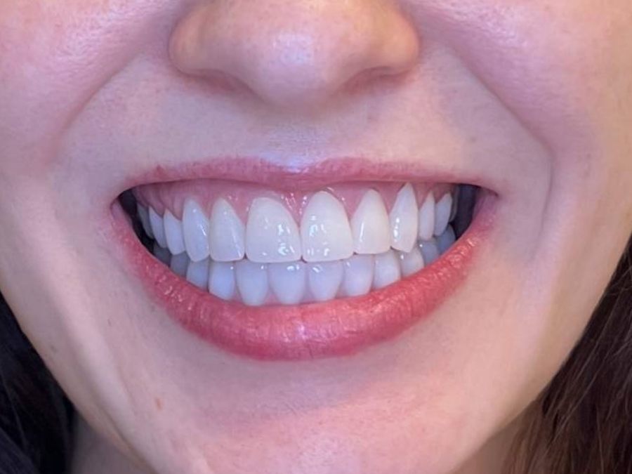 After — fixed full-arch dental implants by Dr. Matthew McClement at Wellness Dental Mesa