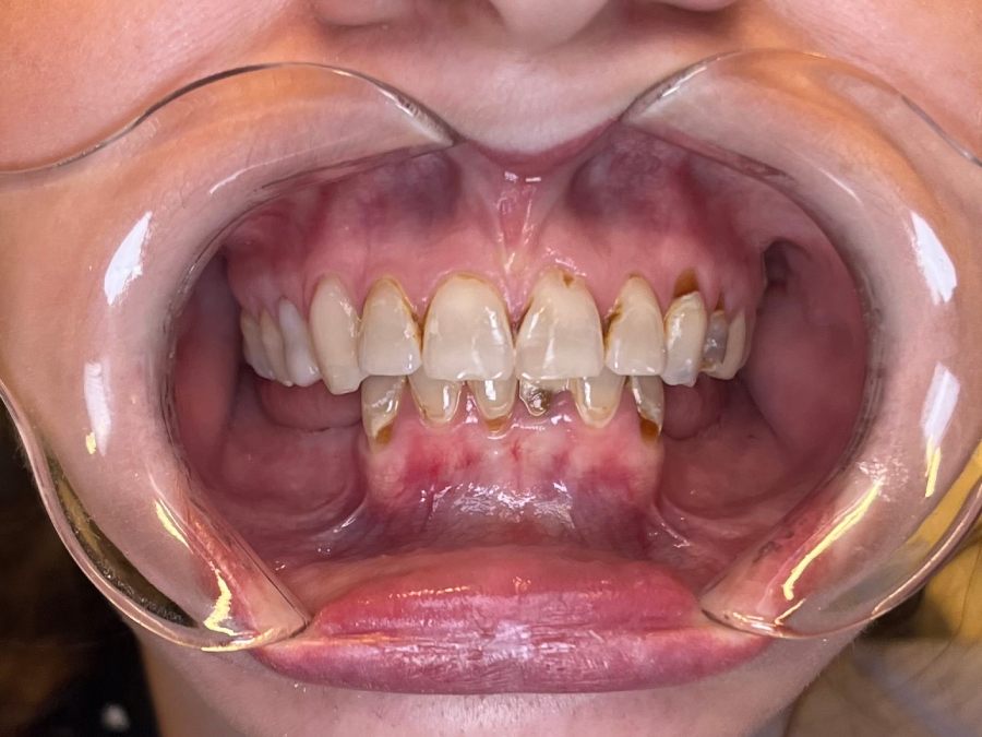 Before — full-arch dental implant case treated by Dr. Matthew McClement at Wellness Dental Mesa