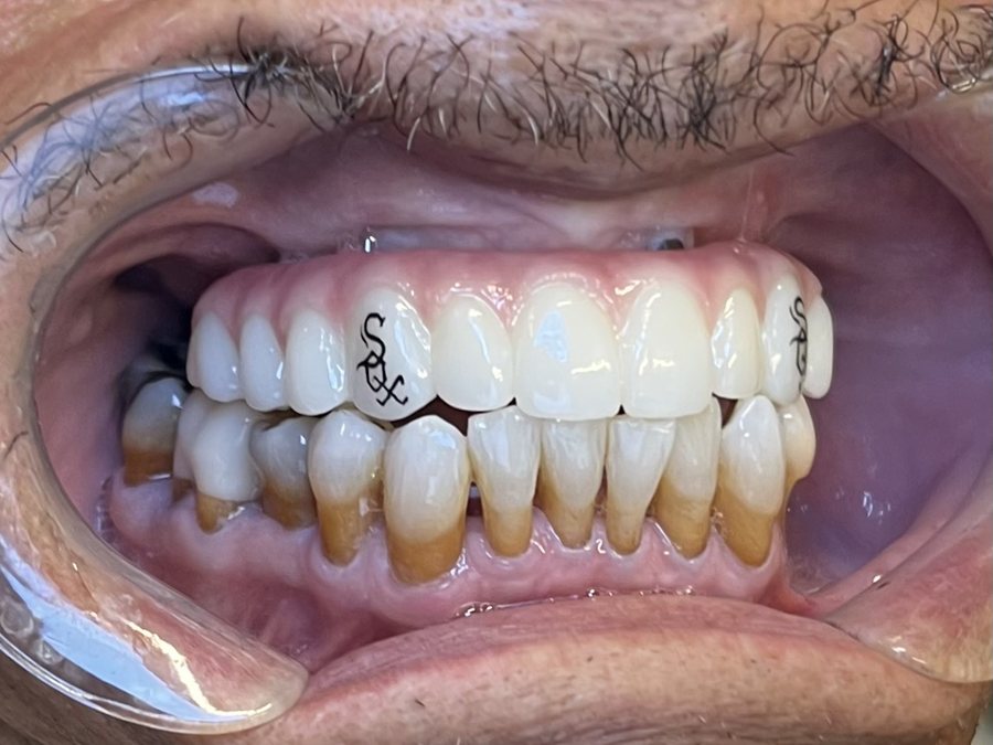 After — fixed full-arch dental implants by Dr. Matthew McClement at Wellness Dental Mesa
