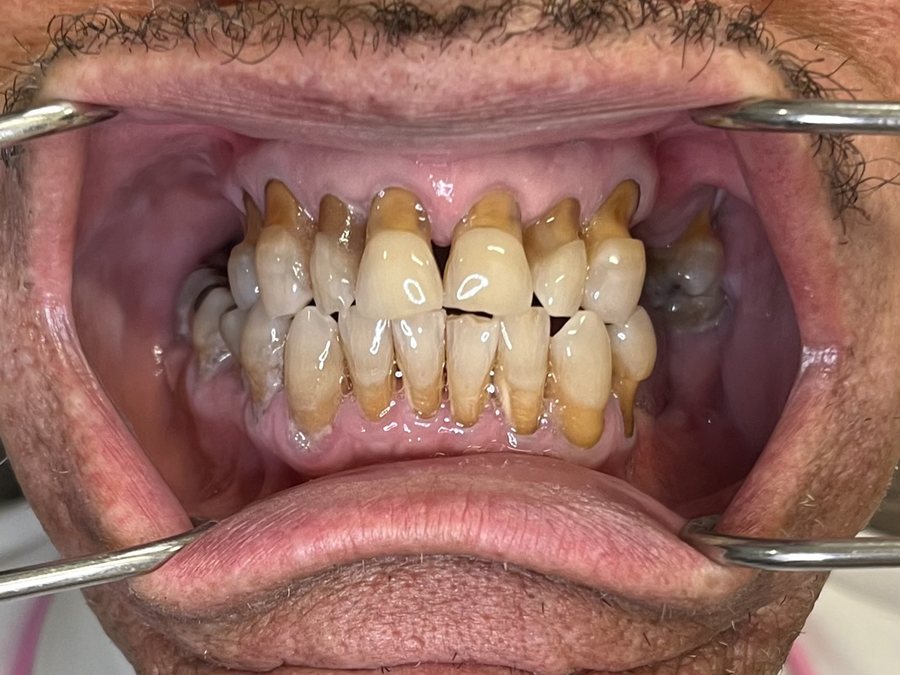 Before — full-arch dental implant case treated by Dr. Matthew McClement at Wellness Dental Mesa