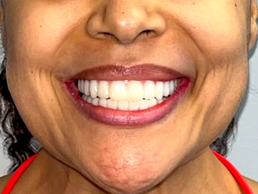 After — fixed full-arch dental implants by Dr. Westermeier at Wellness Dental Glendale
