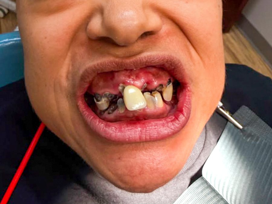 Before — full-arch dental implant case treated by Dr. Westermeier at Wellness Dental Glendale