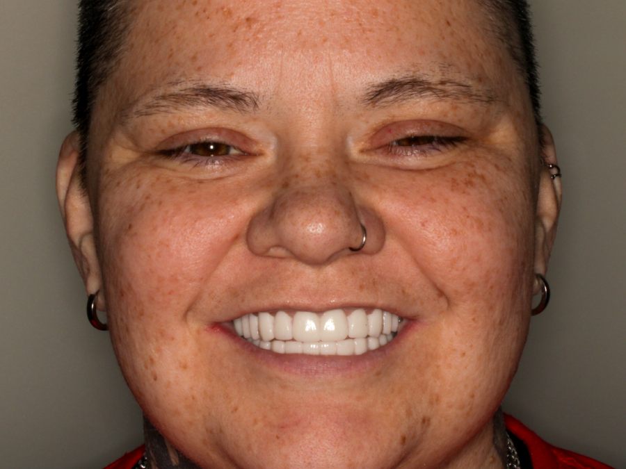 After — fixed full-arch dental implants by Dr. Westermeier at Wellness Dental Glendale