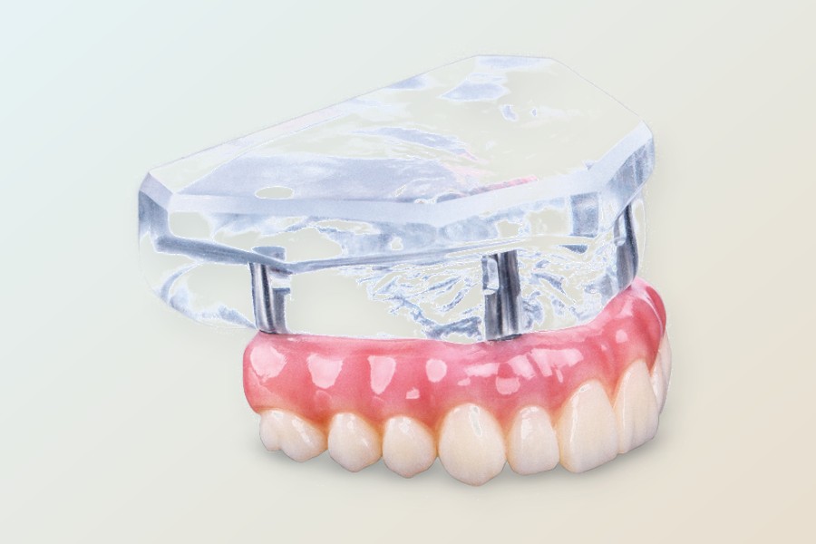 Illustration of a Click Tight implant denture: a natural-looking arch of teeth and the dental implants it snaps securely onto