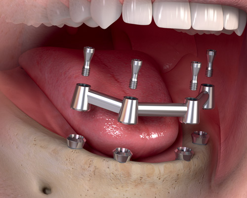 Model of All-on-4 dental implants: a full arch of new teeth supported by four implants