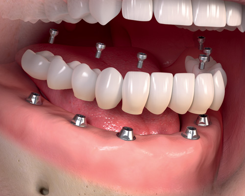 Model of a dental implant bridge: a span of replacement teeth anchored on two dental implants