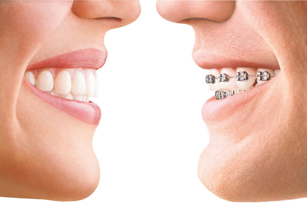 Side-by-side comparison of clear aligner therapy and traditional metal braces